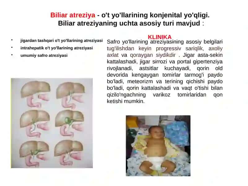 Xoletsistopatiya 2