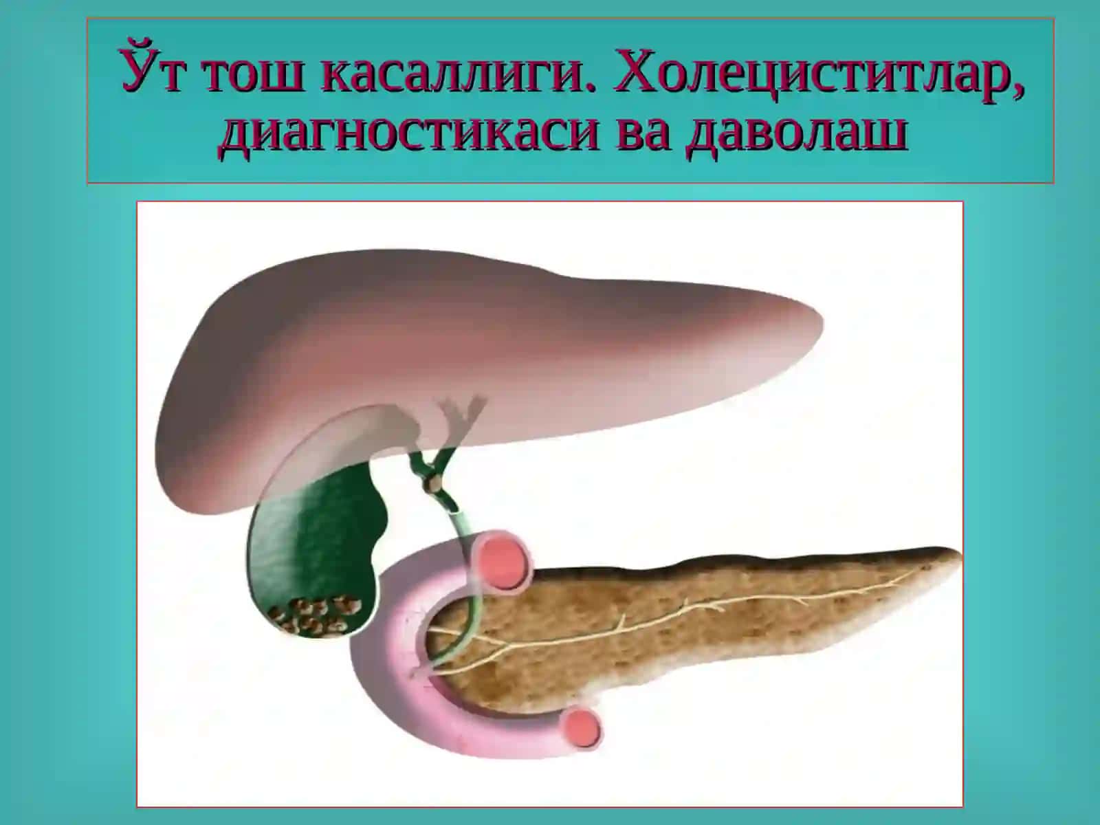 Ўт-тош касаллиги. Холециститлар, диагностикаси ва даволаш 2