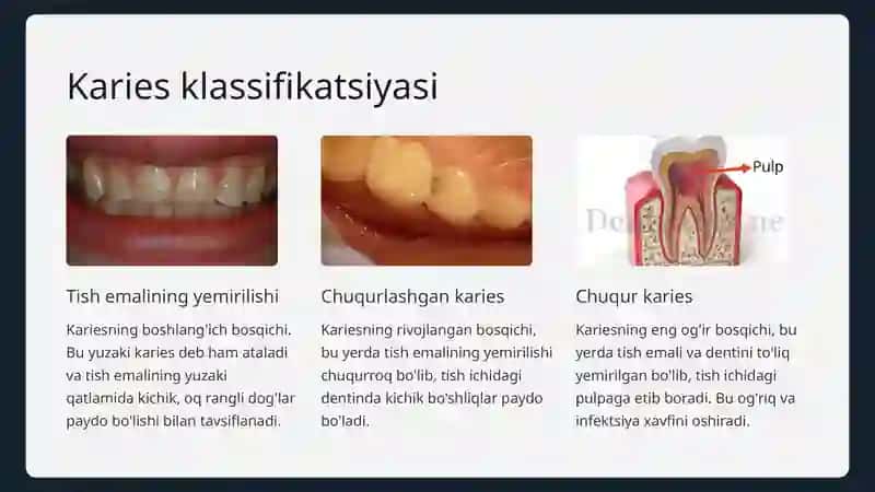 Karies kasalligi va uning tasnifi 2