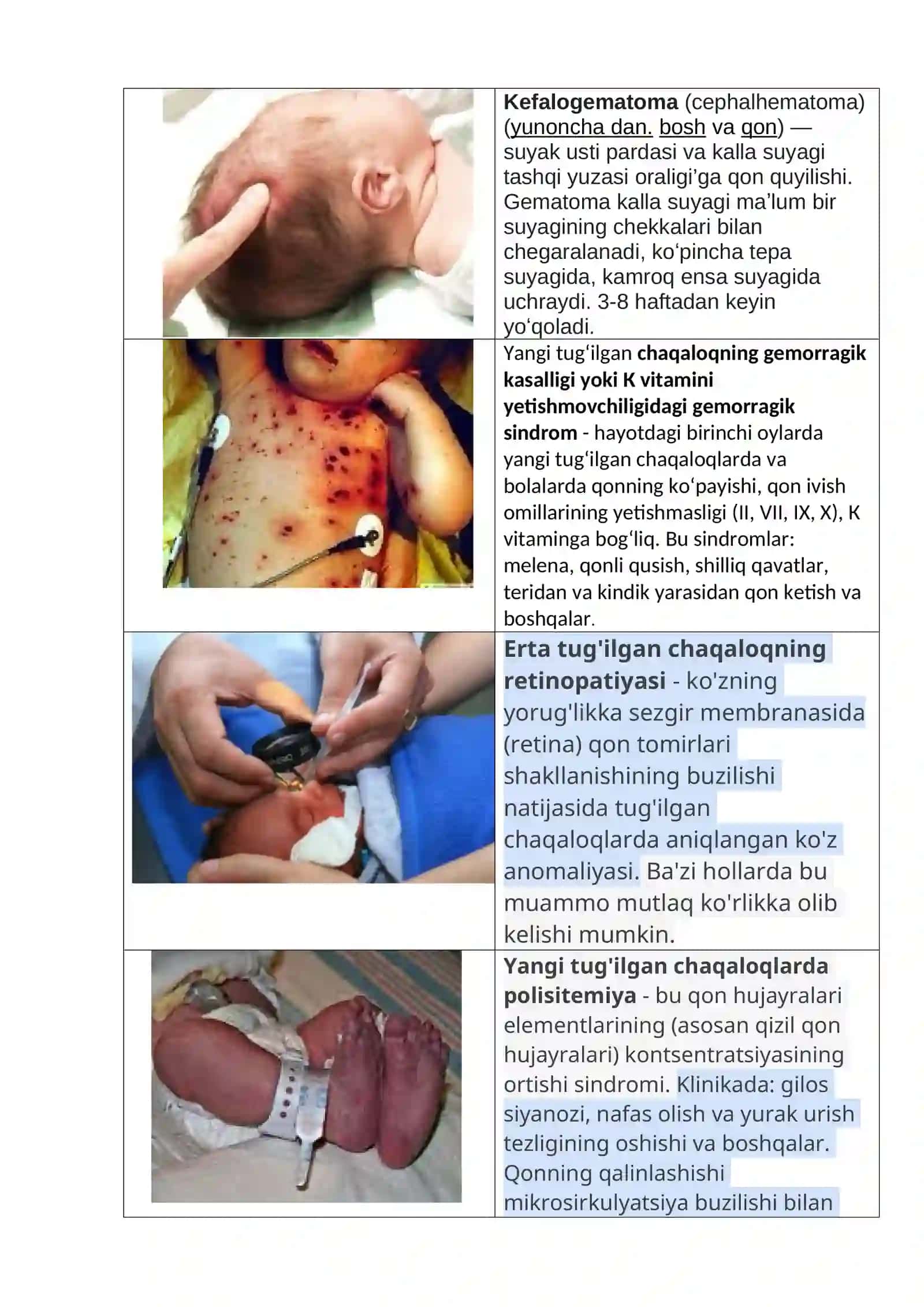 Neonatal Giperbilirubinemiya 2