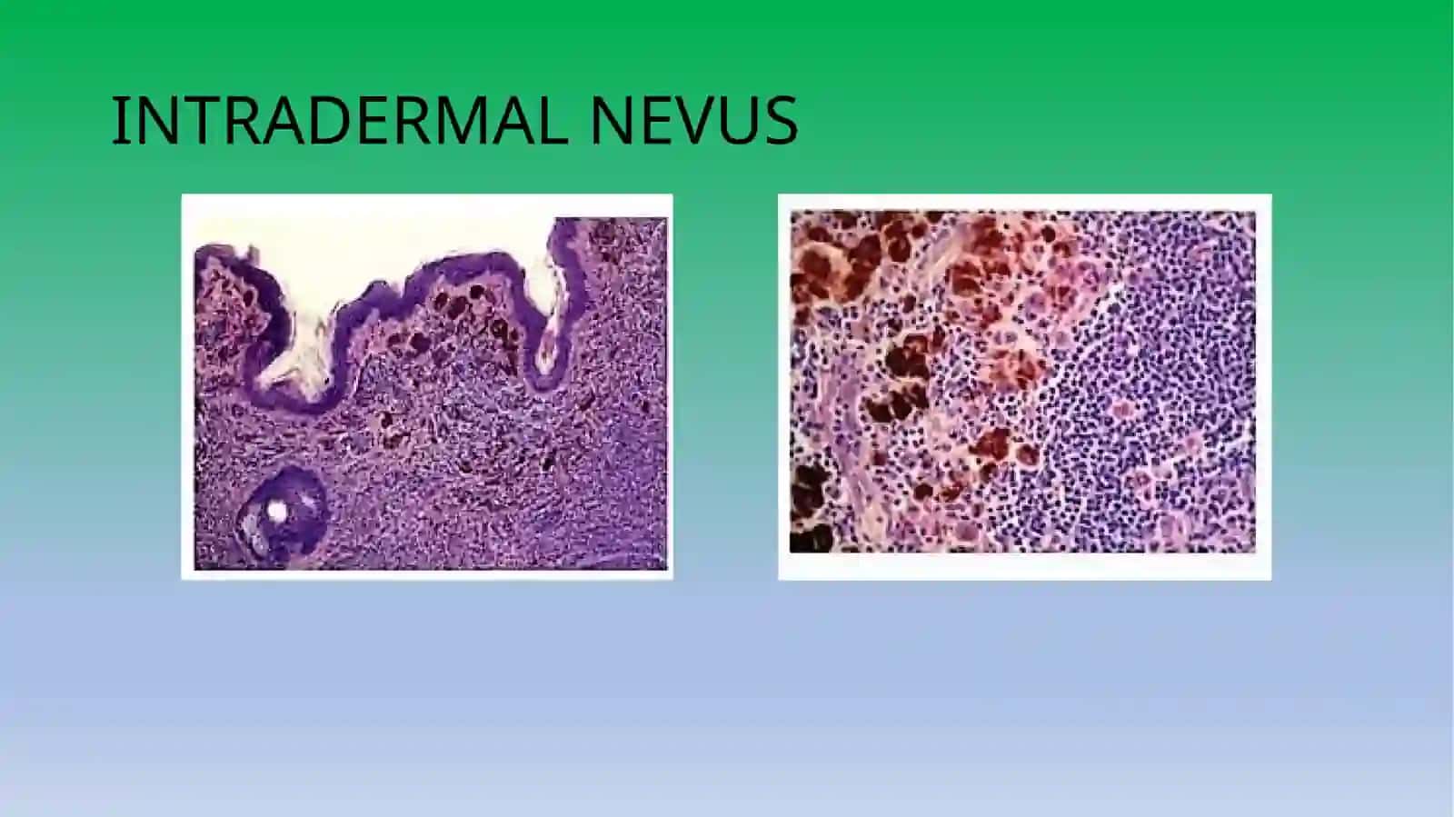 Chegaradagi nevus 2
