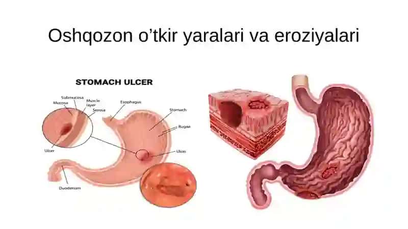 Me’dava o’nik kibi bar moqli ichakning yarakasalligi 2