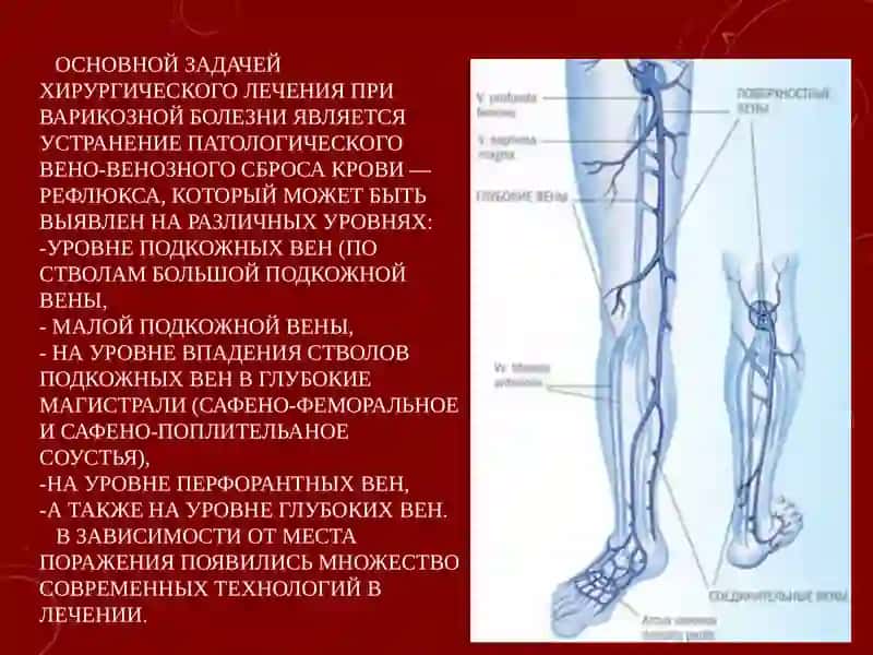 СОВРЕМЕННЫЕ МЕТОДЫ ХИРУРГИЧЕСКОГО ЛЕЧЕНИЯ ВАРИКОЗНОЙ БОЛЕЗНИ НИЖНИХ КОНЕЧНОСТЕЙ 2