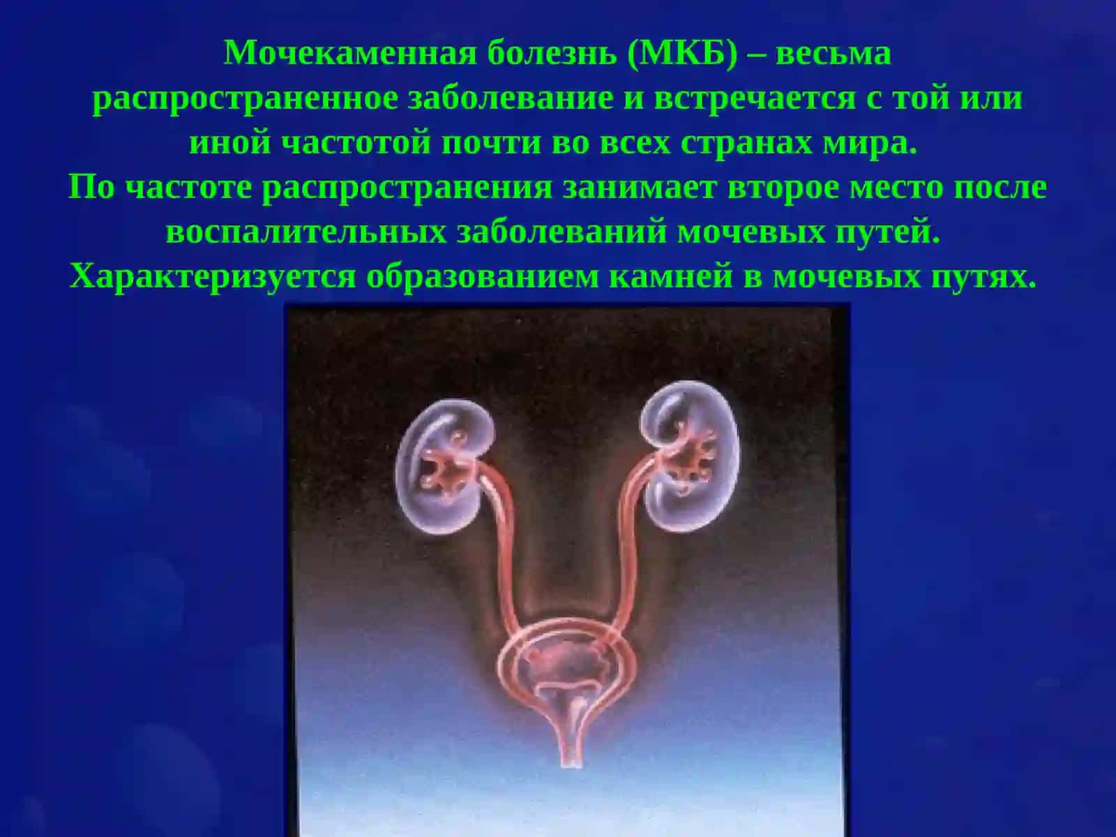 Мочекаменная болезнь (МКБ) 2