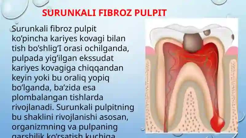 Surunkali fibrozli pulpit 2