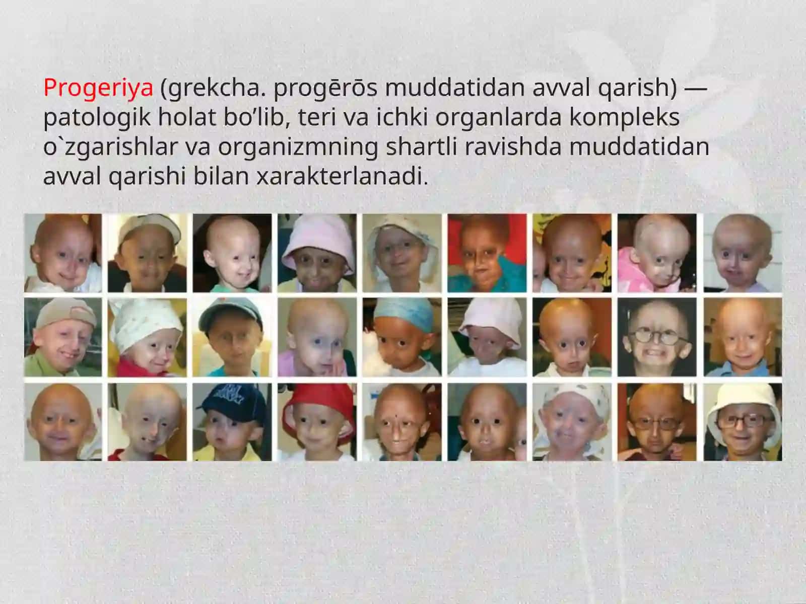 Progeriya 2