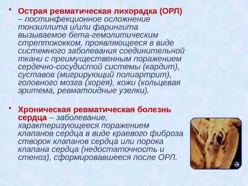 Острая ревматическая лихорадка 2