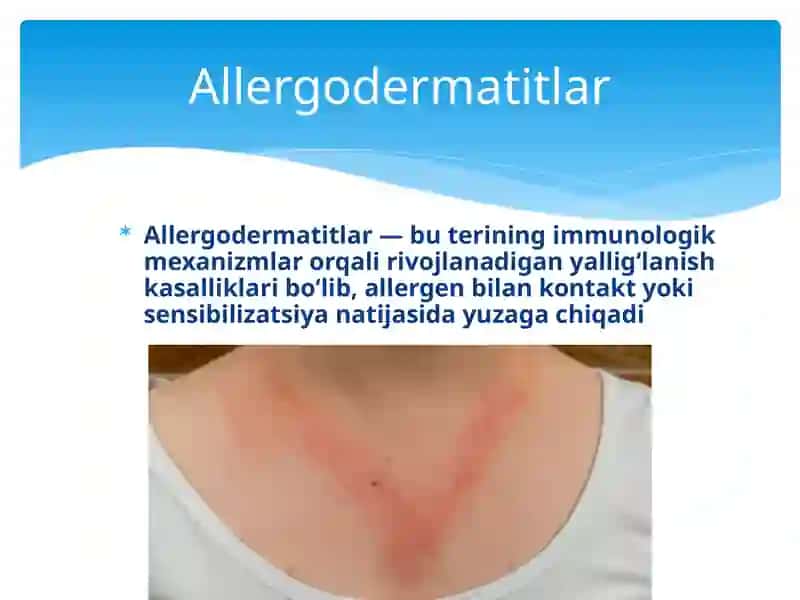 Allergodermatitlar 2