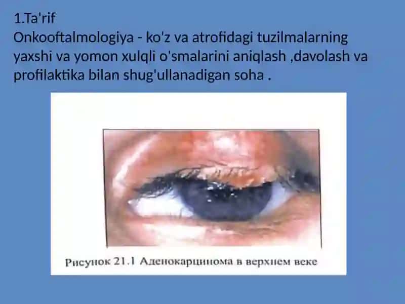 Onkooftalmologiya 2