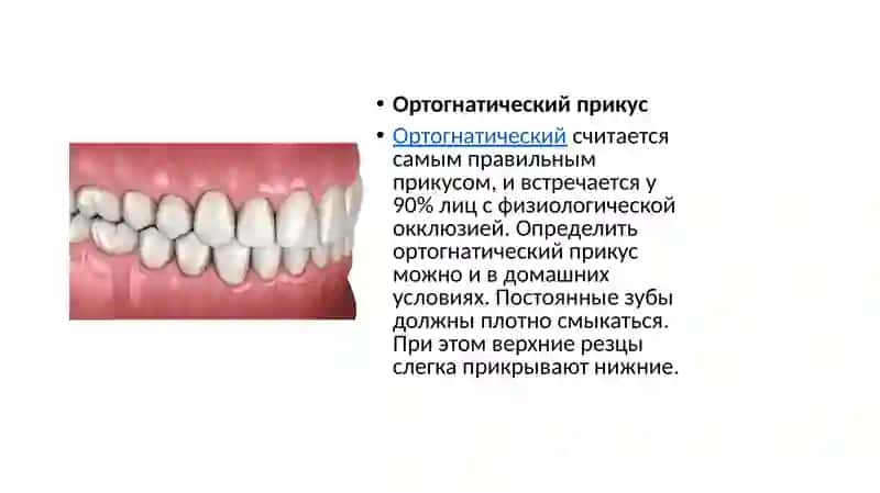 Ортогнатический прикус 2