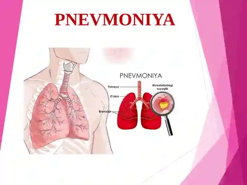 PNEVMONIYA 2
