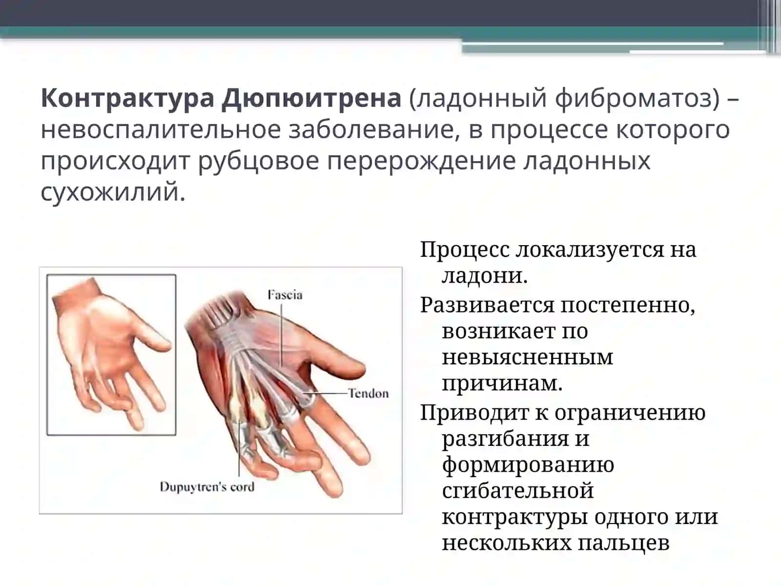КОНТРАКТУРА ДЮПЮИТРЕНА. ЛЕЧЕНИЕ КОЛЛАГЕНАЗОЙ 2