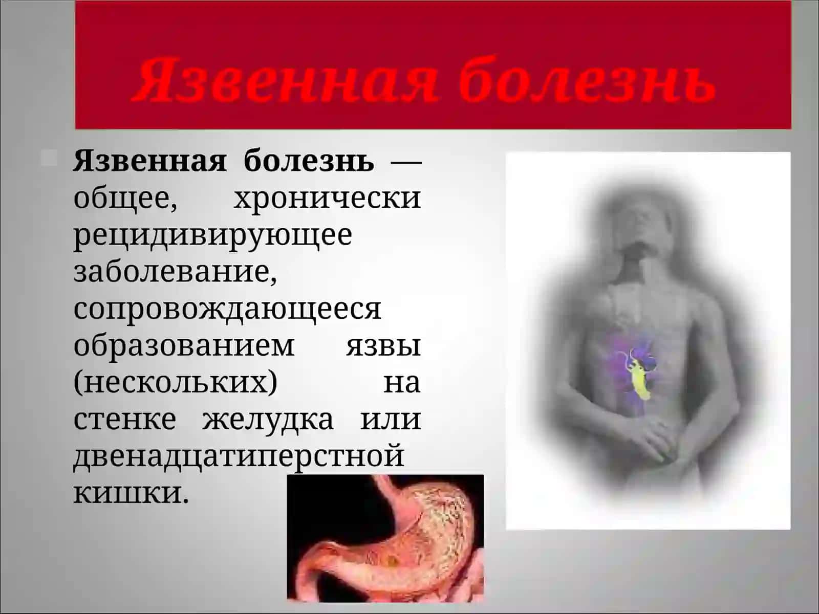 Язвенная болезньжелудка и двенадцатиперстной кишки 2