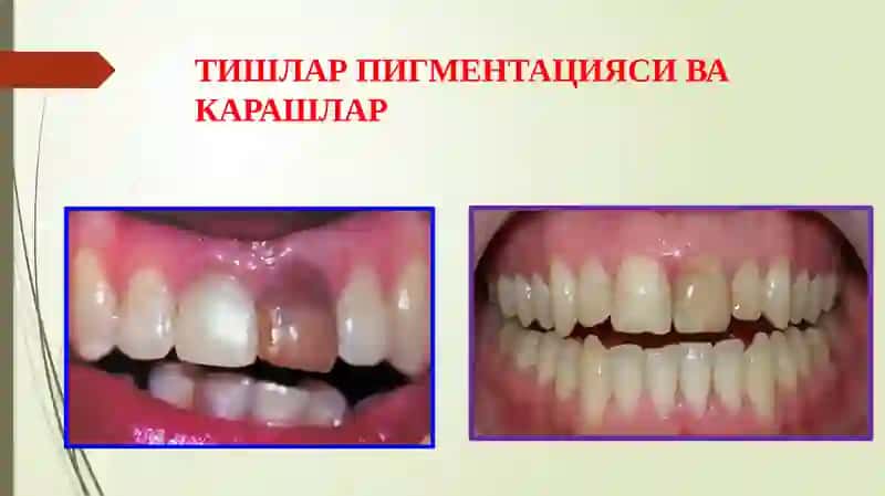 Тишларниоқартириш. Кўрсатма ва қарши кўрсатмалар. Қўллаш услублари 2