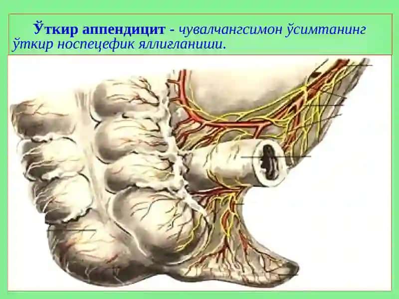 Ўткир аппендицит 2