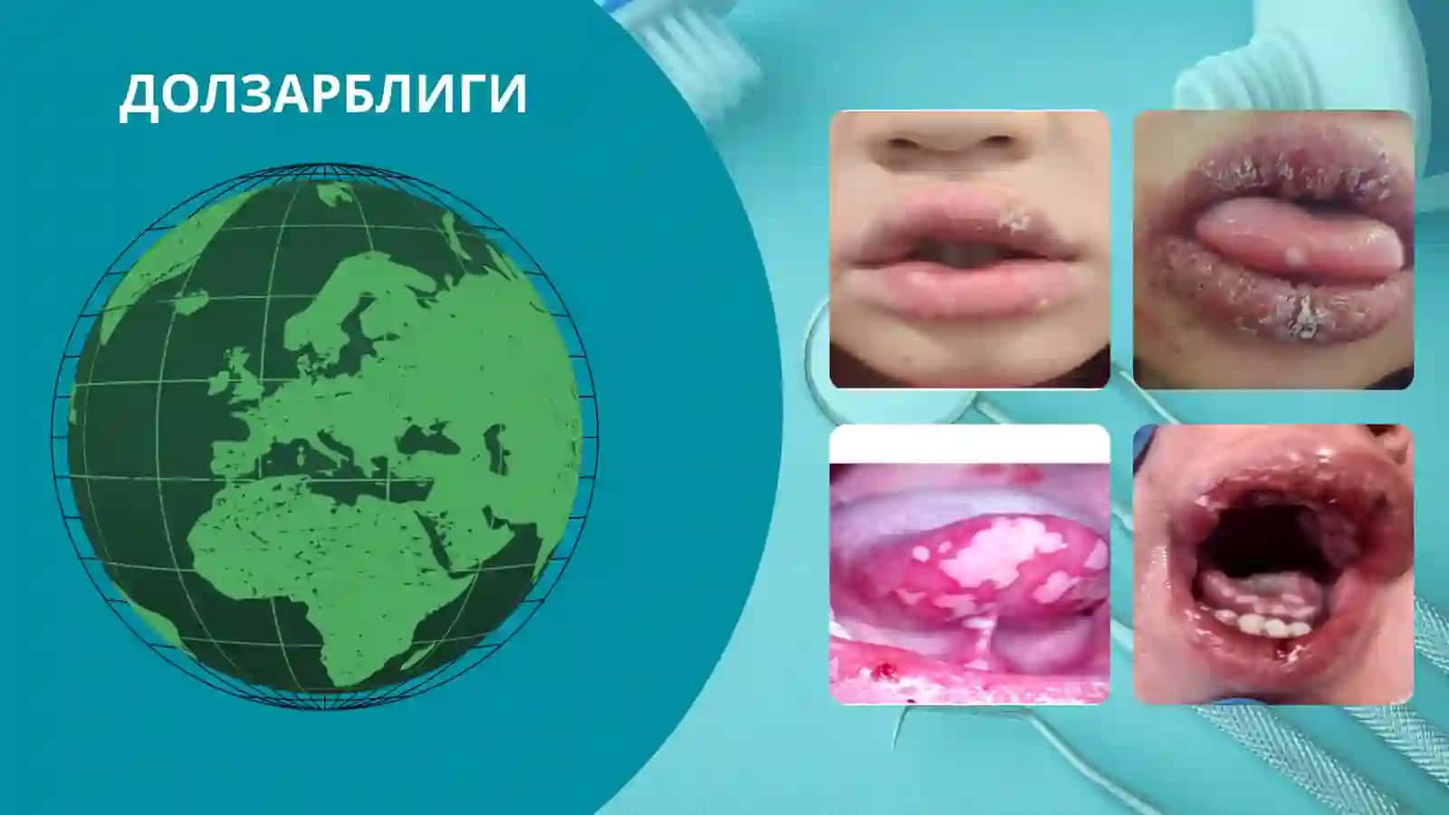 БОЛАЛАРДА ЎТКИР ГЕРПЕТИК ВА КАНДИДОЗЛИ СТОМАТИТЛАРНИ ДАВОЛАШ КОМПЛЕКСИНИ ОПТИМАЛЛАШТИРИШ 2