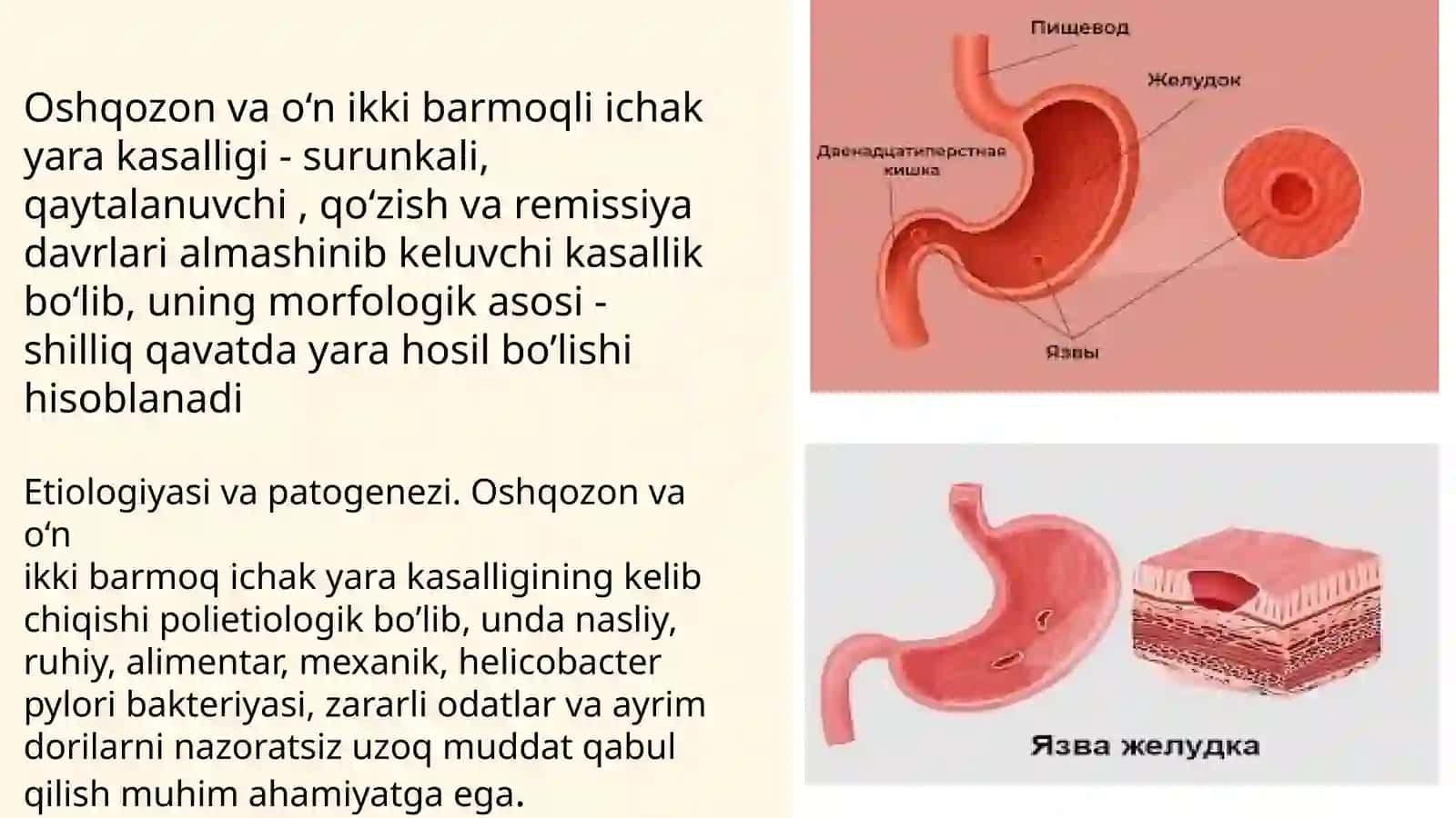 Oshqozon va o‘n ikki barmoqli ichak yara kasalligi asoratlari, diagnostikasi 2
