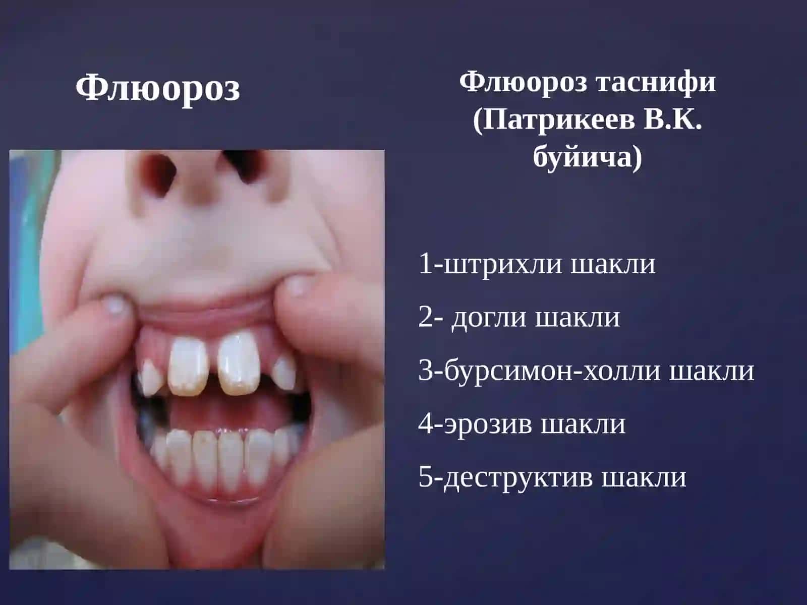 Флюороз 2