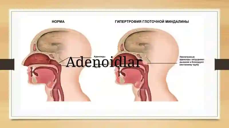 Adenoidlar 2