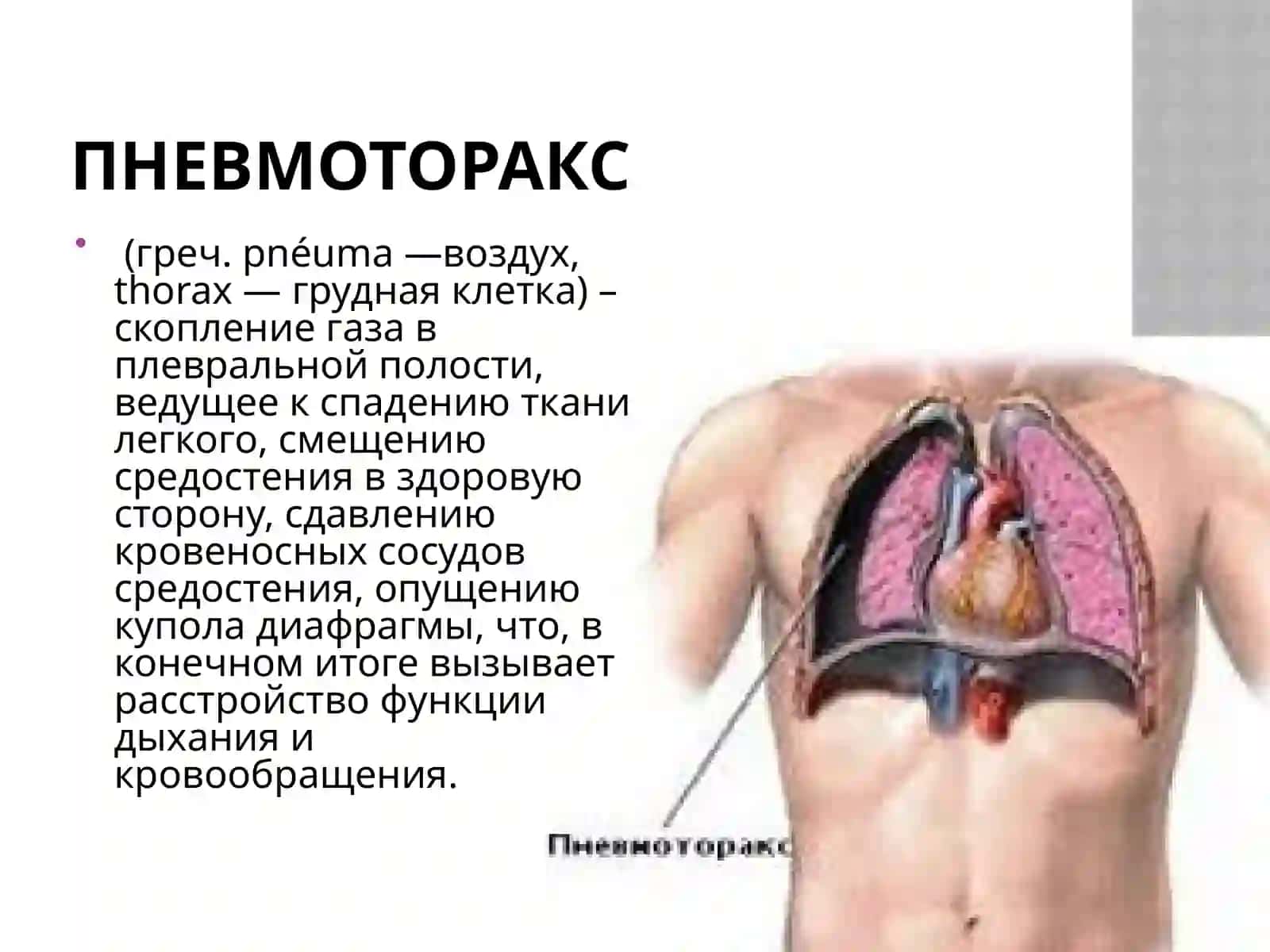 Пневмоторакс Классификация пневмоторакса 2