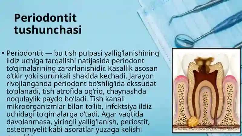 O‘tkir va surunkali periodontitlarni ambulator sharoitda davolash. O‘tkir periodontit shakllarida 2