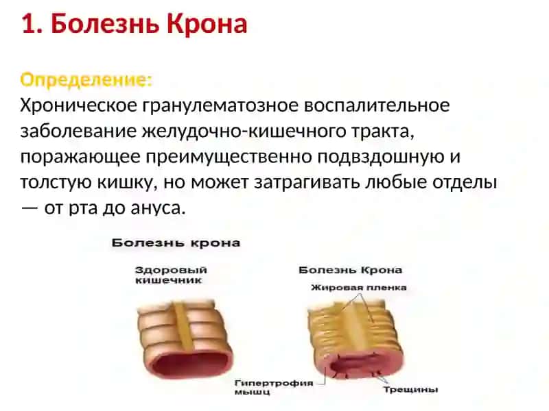 Болезнь Крона. Дисбактериоз кишечника. Болезнь Уиппла. Синдром раздражённого кишечника. 2