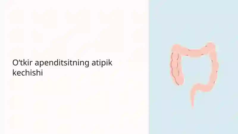 Oʻtkir apenditsit atipik kechishi 2