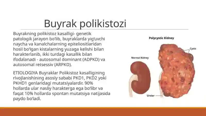 Nasliy Nefropatiyaar pptx Buyraklar polikistozi 2