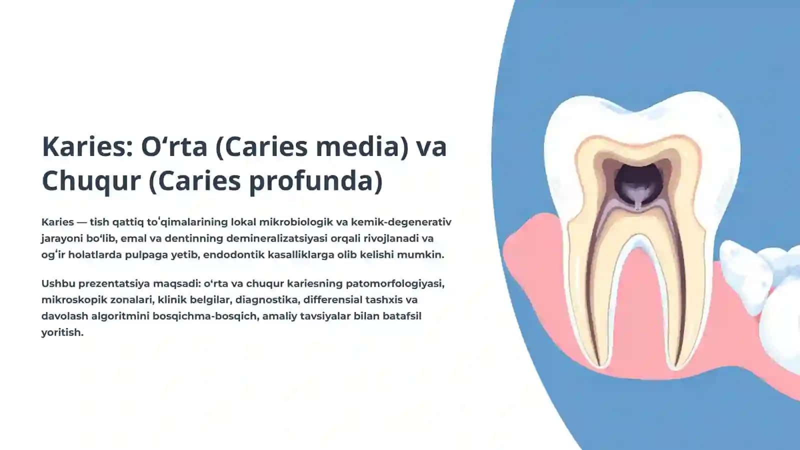 Karies: Oʻrta (Caries media) va Chuqur (Caries profunda) 2