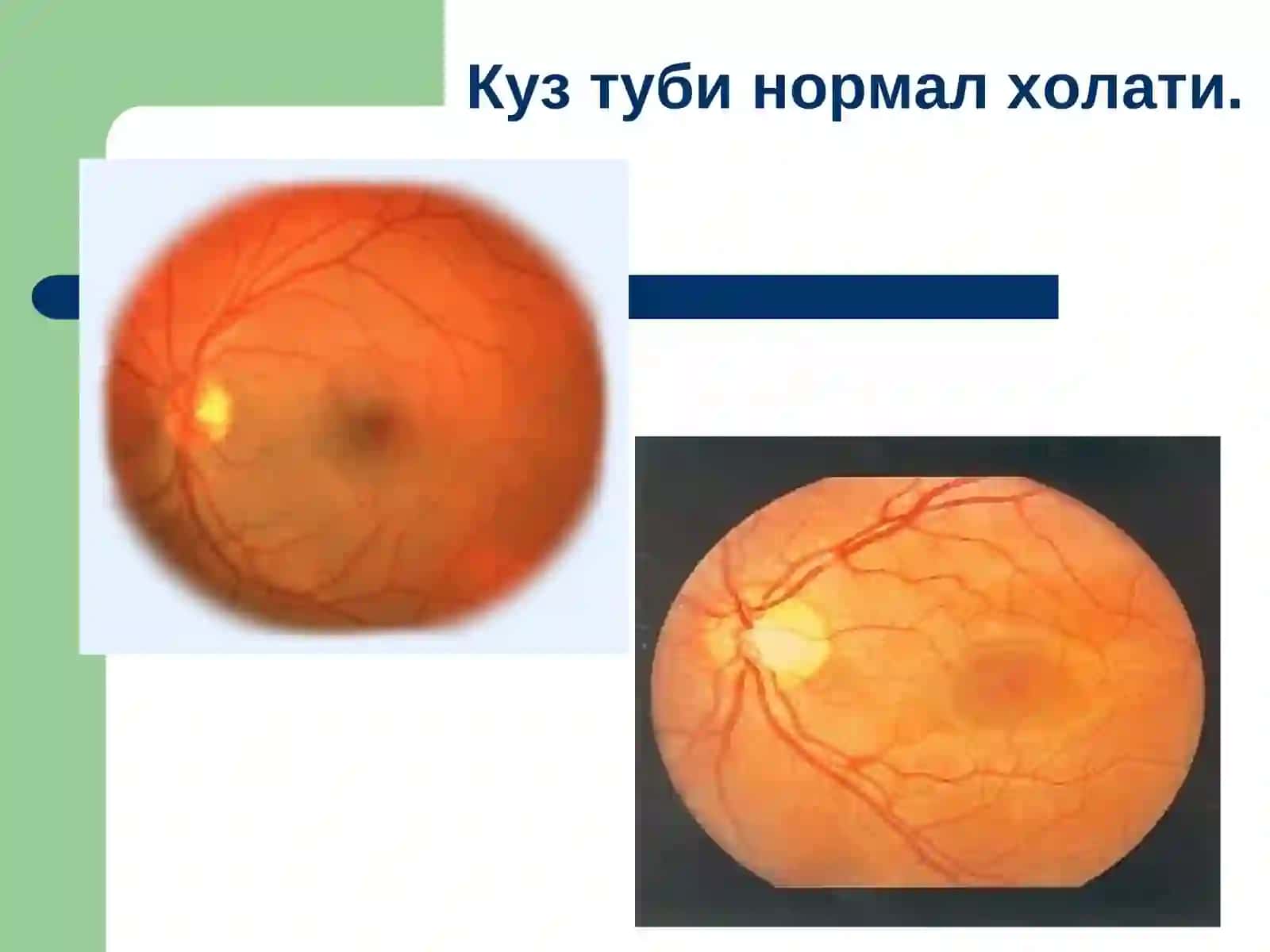Умумий касалликларда кузатиладиган тўр пардадаги патологик ўзгаришлар 2