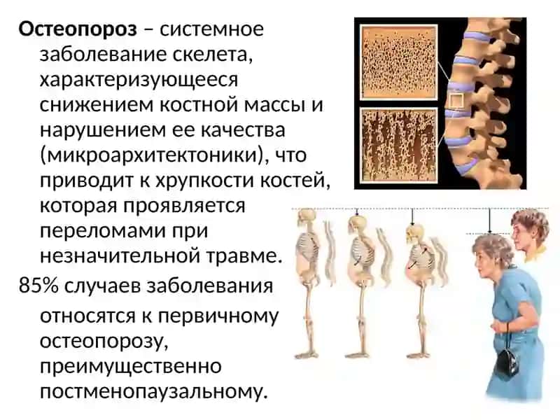 Остеопороз 2