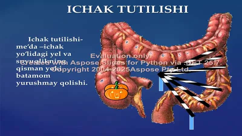 Orttirilgan oʻtkir ichak tutilishi 2