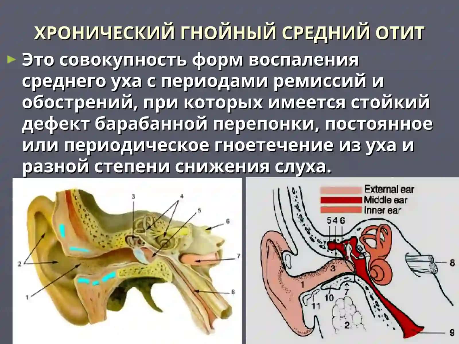 ХРОНИЧЕСКИЙ ГНОЙНЫЙ СРЕДНИЙ ОТИТ. ТИМПАНОПЛАСТИКА.ОТОГЕННЫЕ ВНУТРИЧЕРЕПНЫЕ ОСЛОЖНЕНИЯ 2