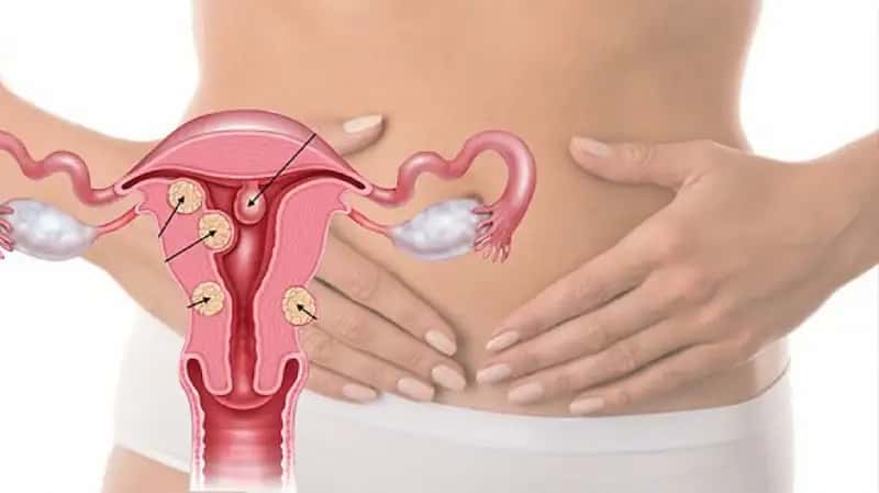 Mioma: etiopatoggenezi, klinikasi, tashhislash, davolash tamoyillari 2