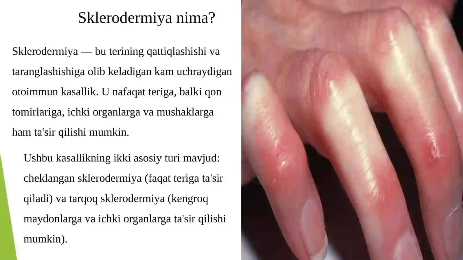 Sklerodermiya: Hayotni Tushunish va Boshqarish 2