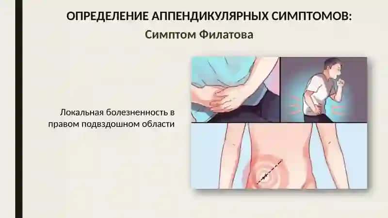 Ректальное исследование при тазовом аппендиците 2