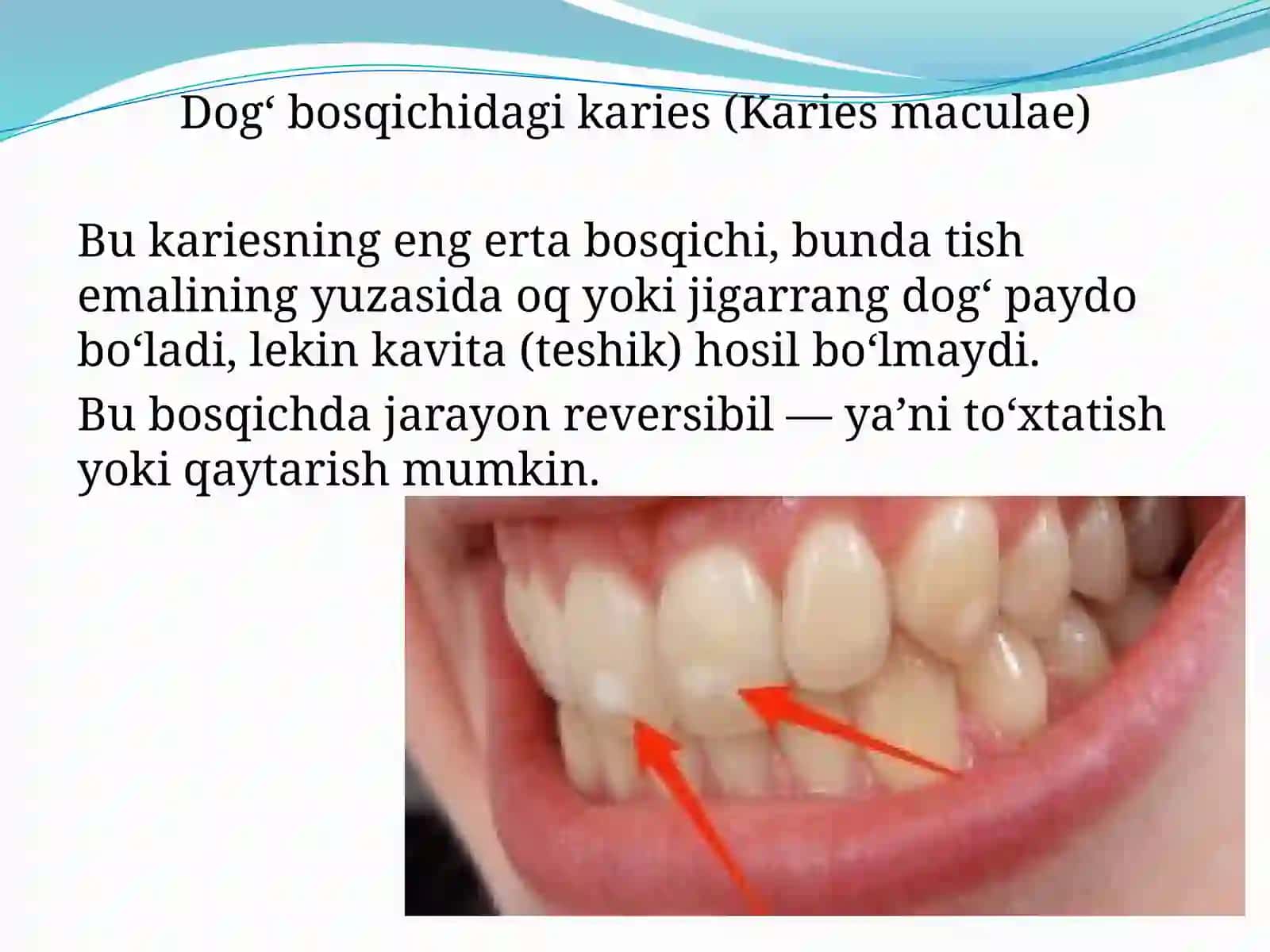 O'tkir va surunkali dog` bosqichidagi kariesni davolash usullari. Receptura. Kasallikni oldini olish 2