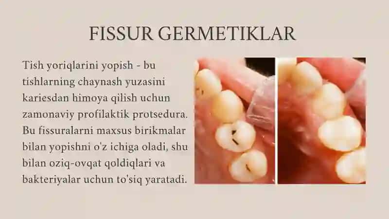 FISSUR GERMETIKLAR 2