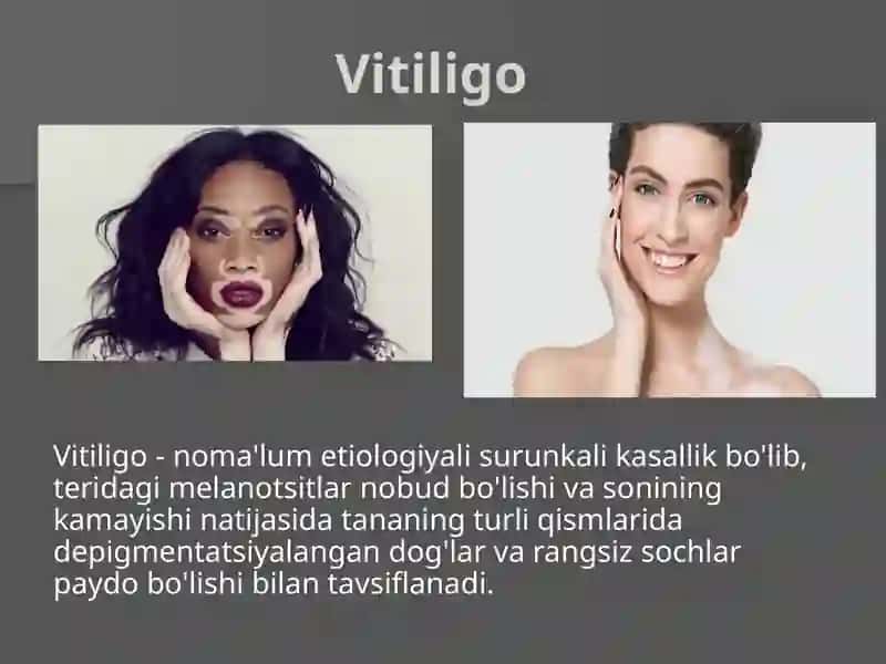 Vitiligo 2