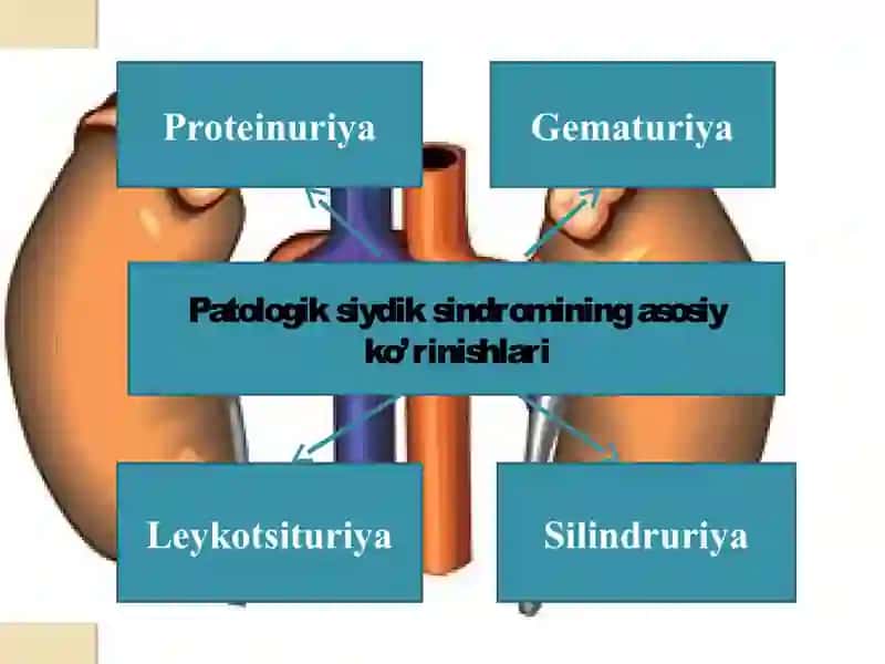Siydik chiqaarish yo’llari neyrogen disfunksiyasi 2