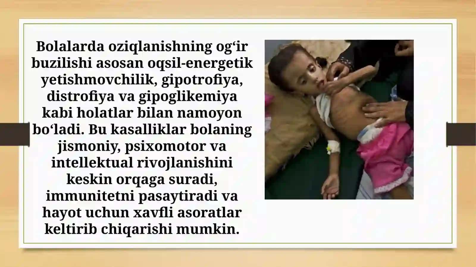 Bolalarda oziqlanish buzilishi. Oqsil-energetik yetishmovchiligi 2