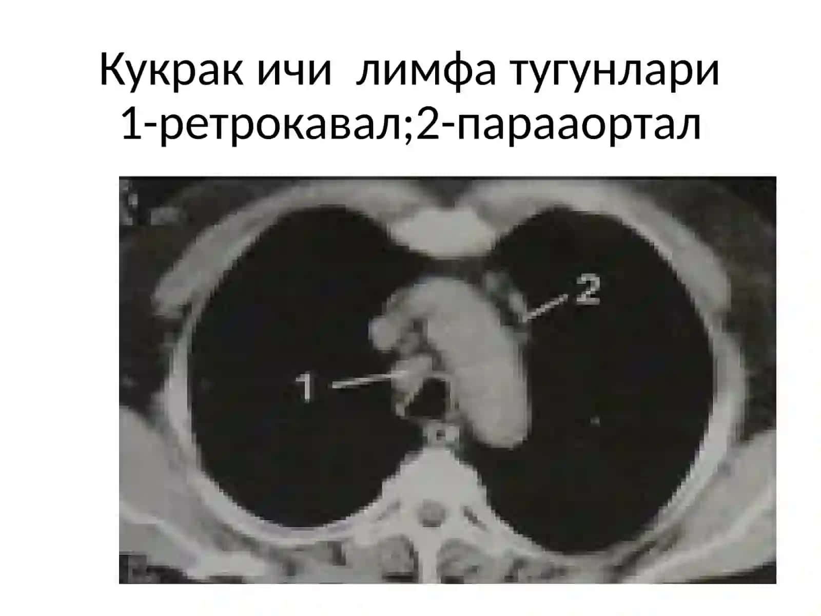 ФТИЗИАТРИЯБУЙИЧАРЕНТГЕНОГРАММАЛАР АЛЬБОМИ 2