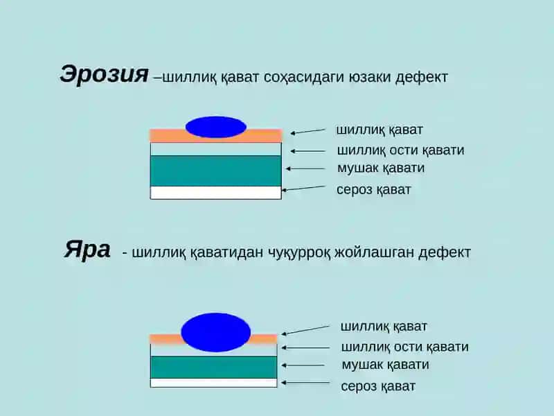 Меъда ва 12 бармоқли ичак Яра касаллиги 2