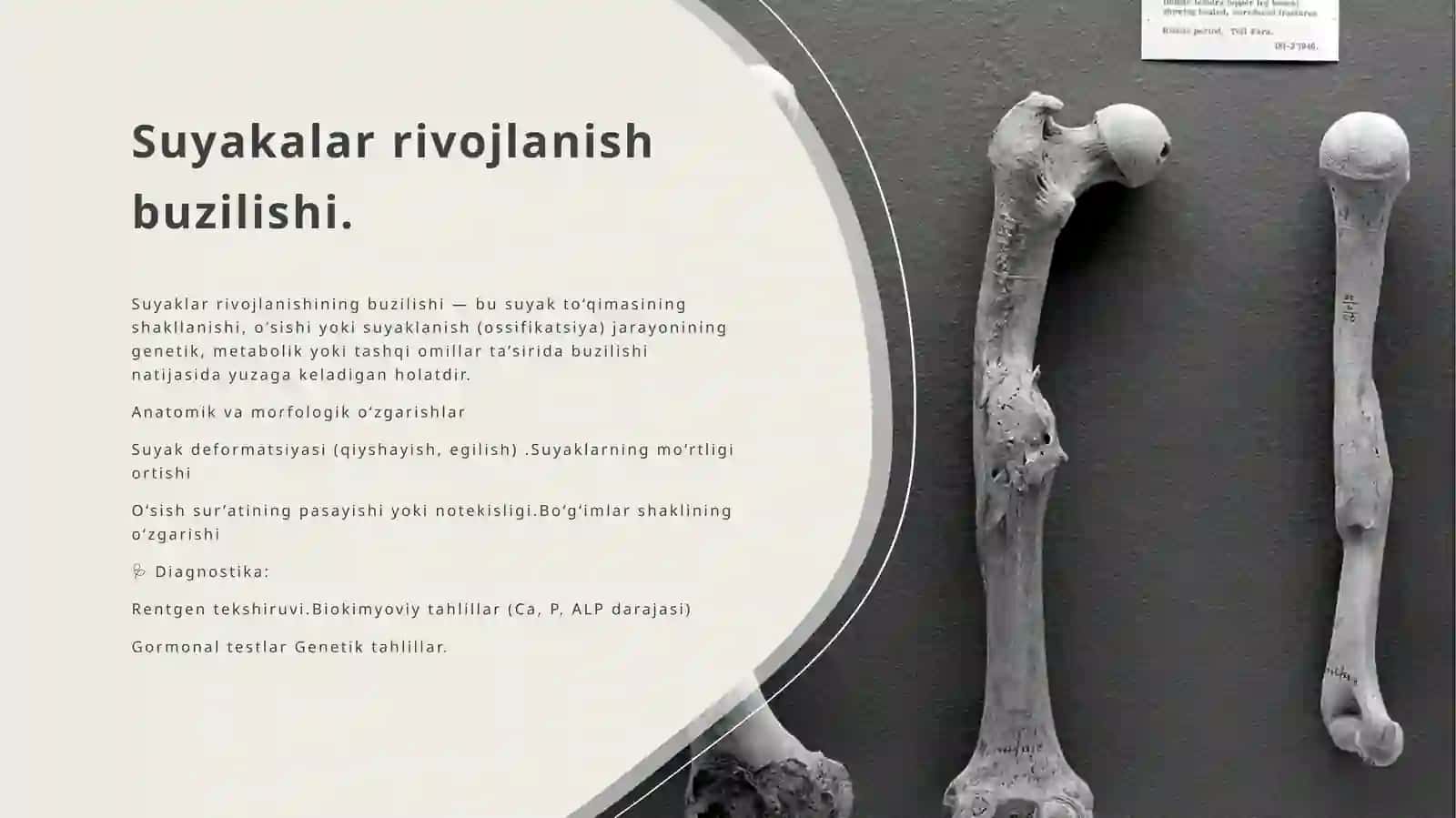 Suyaklar rivojlanishi buzilishi sinishlar.osteonekroz 2