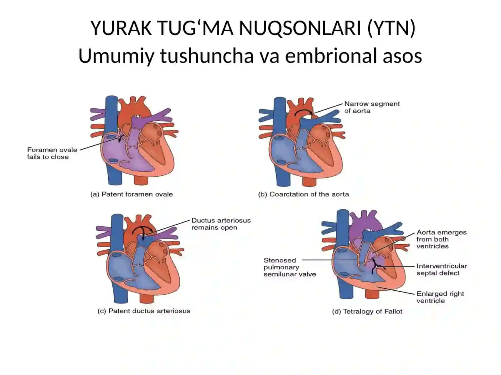 Yurak tug’ma nuqsonlari 2