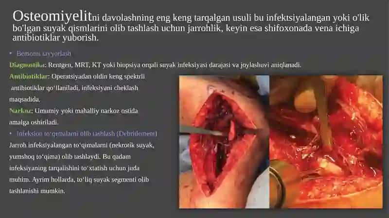 OSTEOMIYELITDA BAJARILADIGAN OPERATSIYA 2