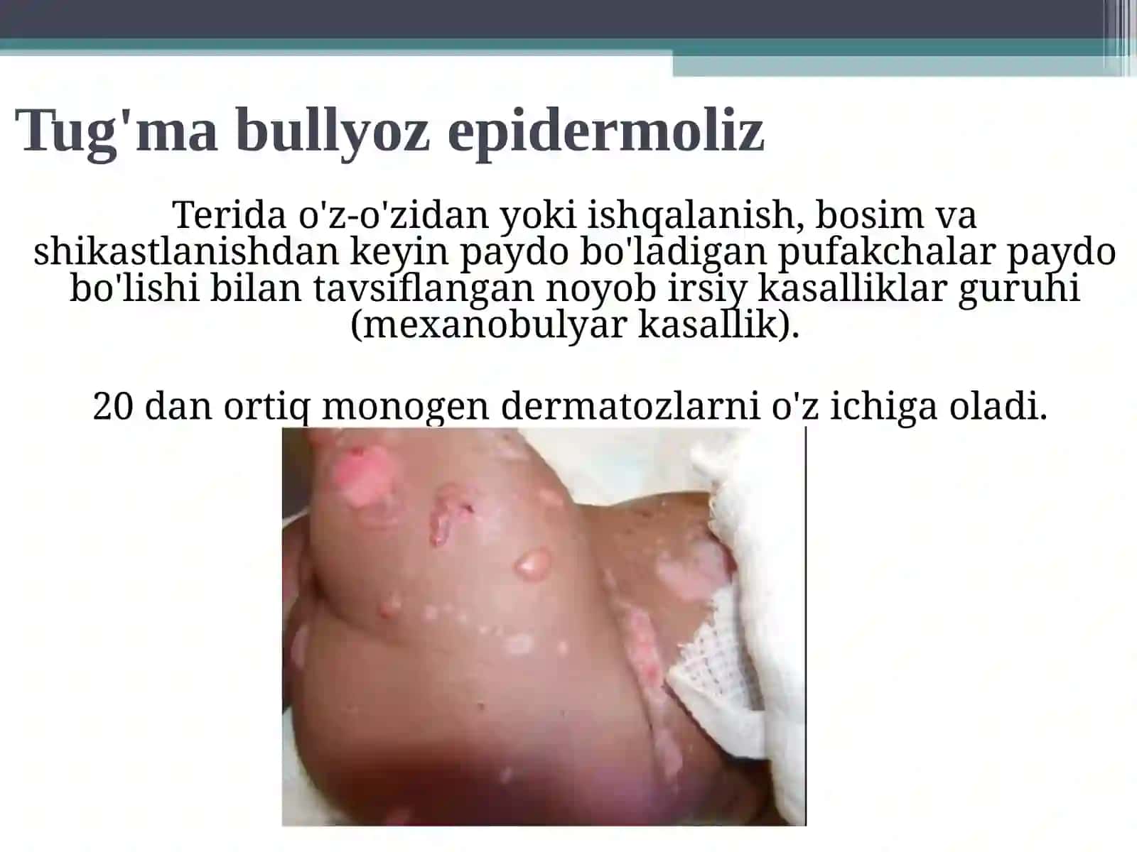 Bullyoz epidermoliz, Xeyli–Xeyli kasalligi 2