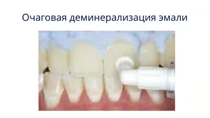 Методы клинической диагностики очаговой деминерализации эмали 2