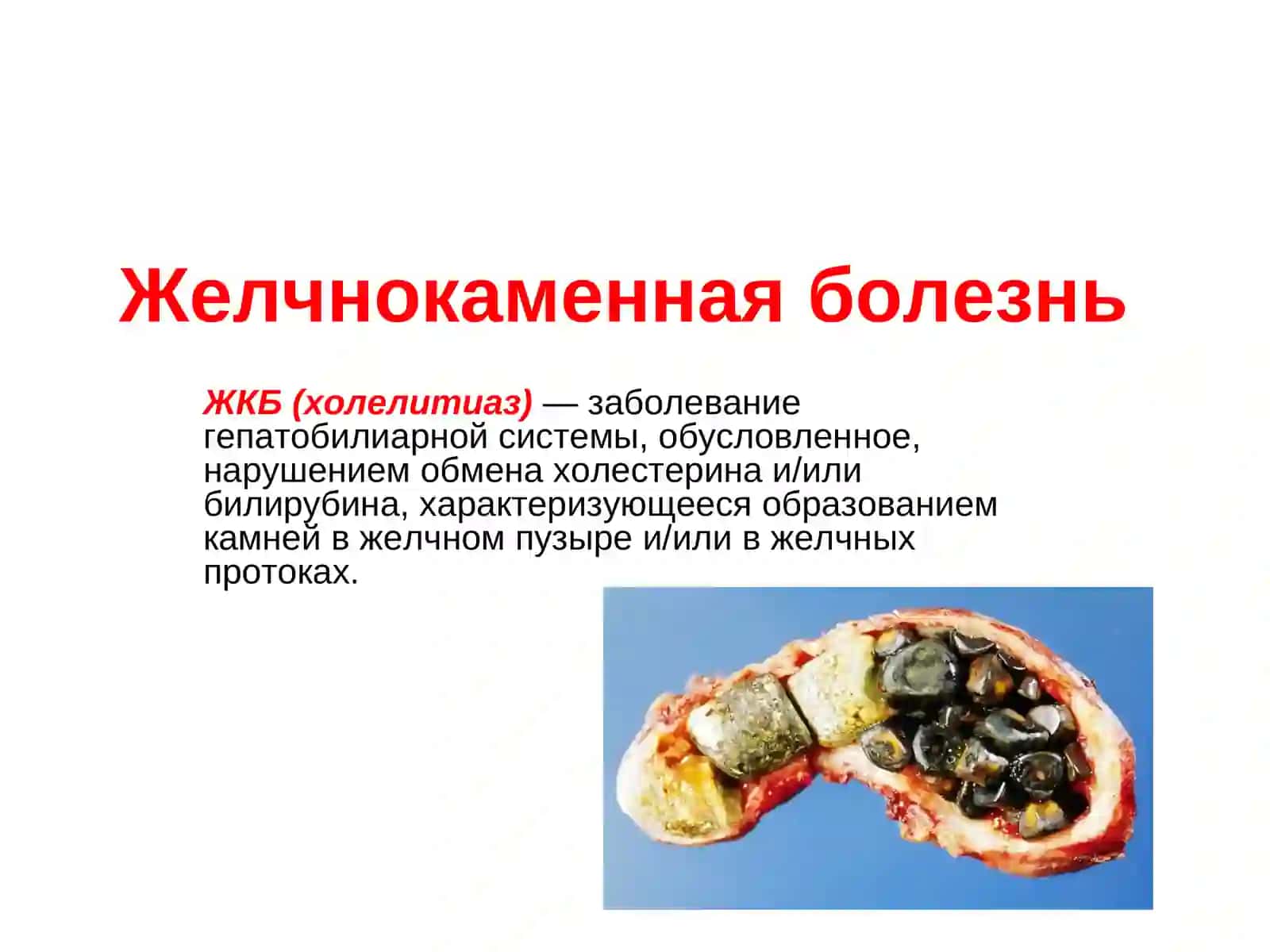 Прионные заболевания. Желчнокаменная болезень 2