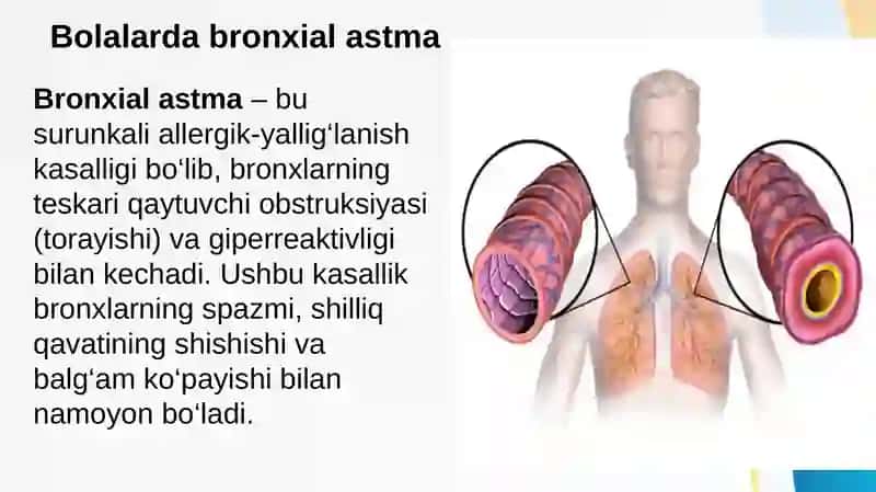 Bolalar va chaqaloqlarda Bronxial asma tasnifi klinikasi etiopatogenezi klassifikatsiasi davolash profilaktikasi 2